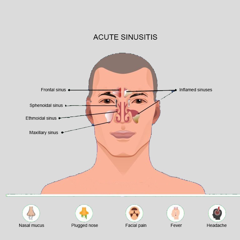 Sinusitis Symptoms